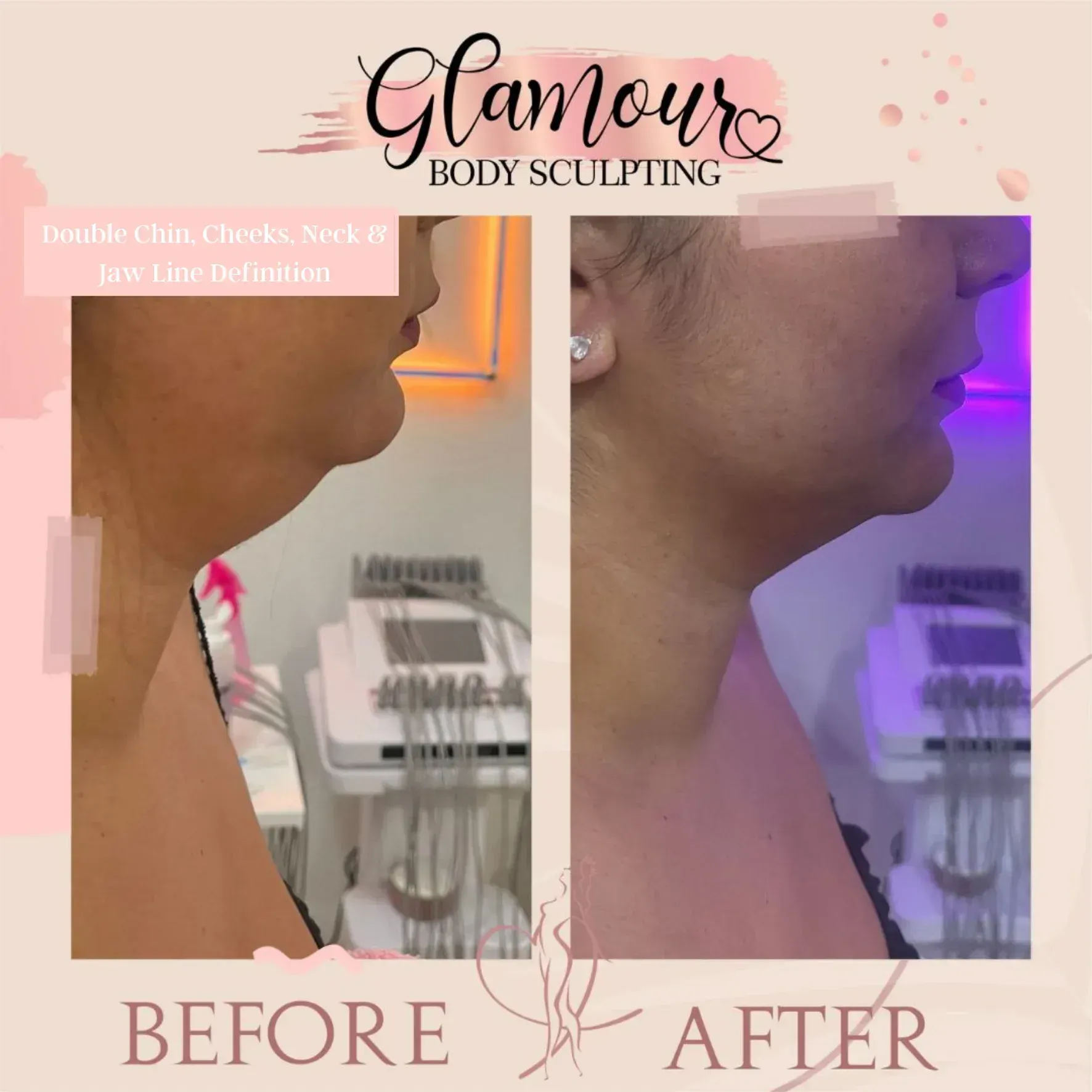 Before-and-after of a neck, cheek, and jawline, showing a reduction of fat after body sculpting.