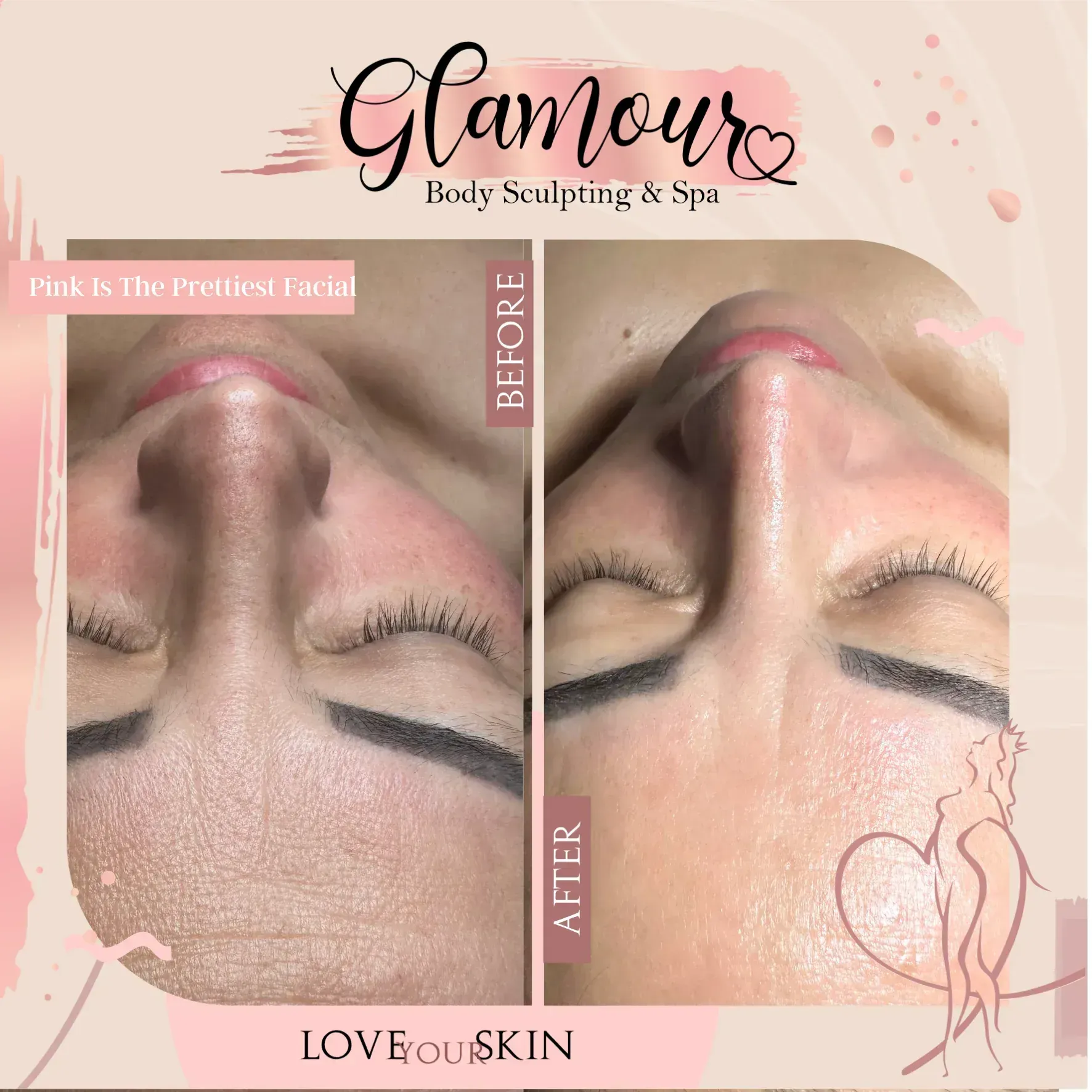 Side-by-side view of a face before and after a treatment, with reduced wrinkles and smoother skin.