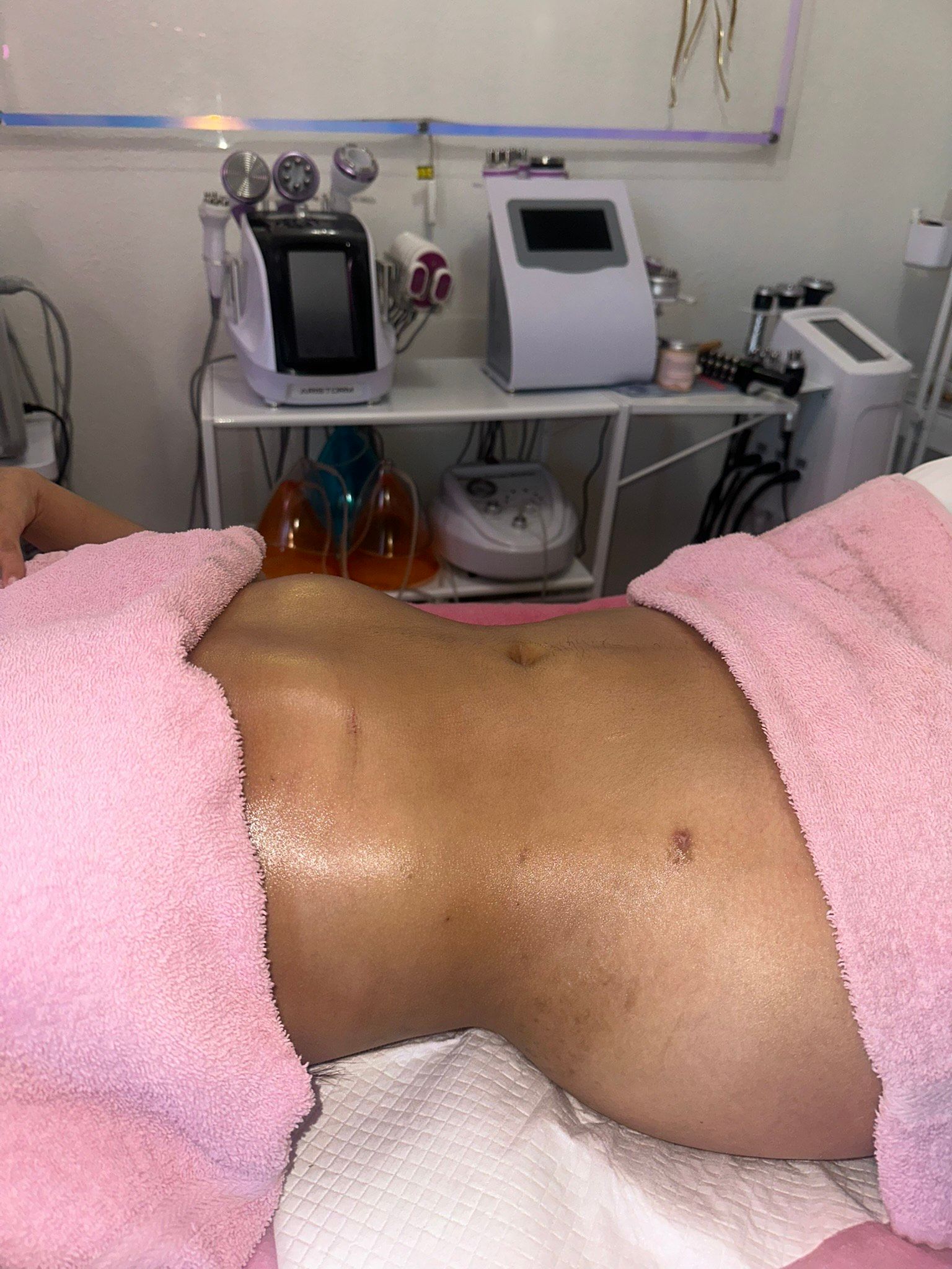 Person's abdomen in a treatment setting, wrapped in a pink towel. Skin appears oily. Beauty equipment in the background.
