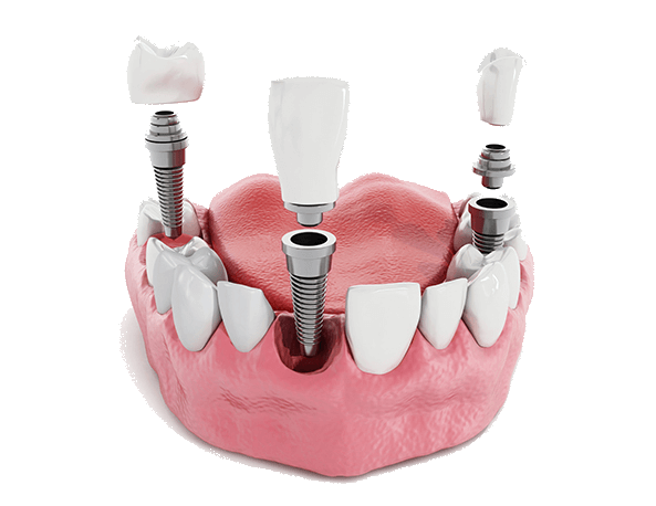 Dental Implant Solution