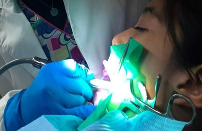 DENTAL KIDS - SELLADORES DE FOCETAS Y FISURAS