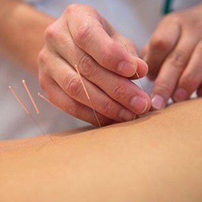 A Client Having Acupuncture — San Pedro, CA — The Vital Chiropractic Center