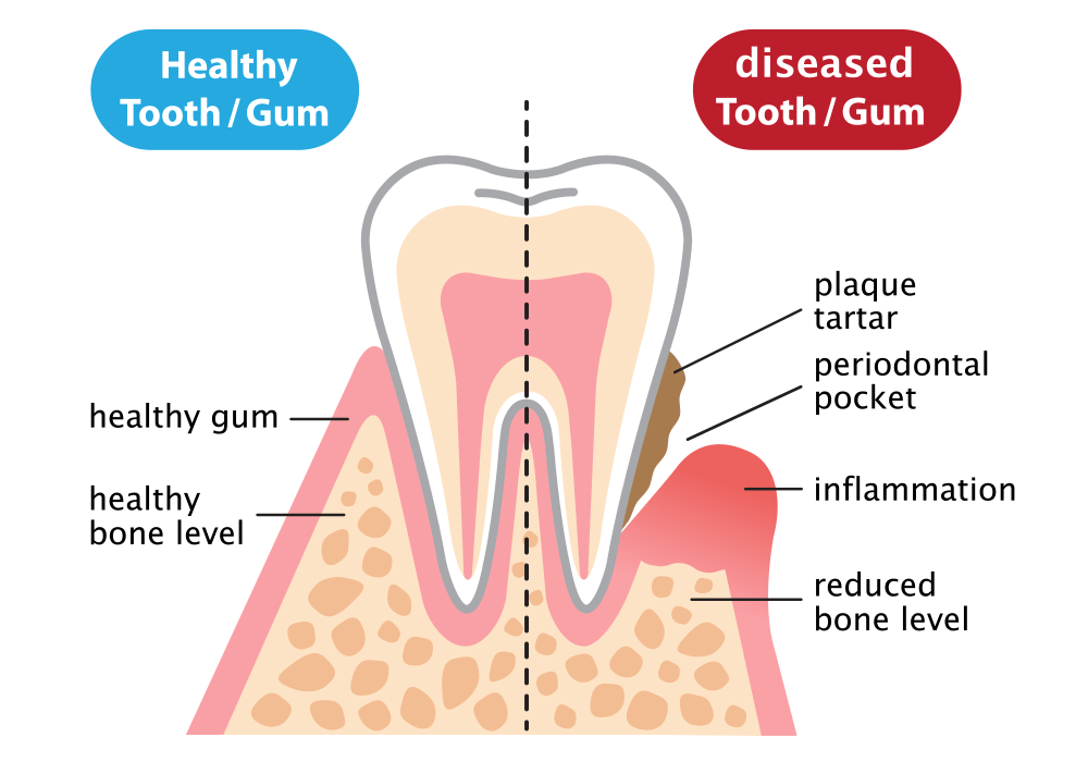Periodontal Treatment — Healthy and inflammatory diseased gum in Richmond, VA