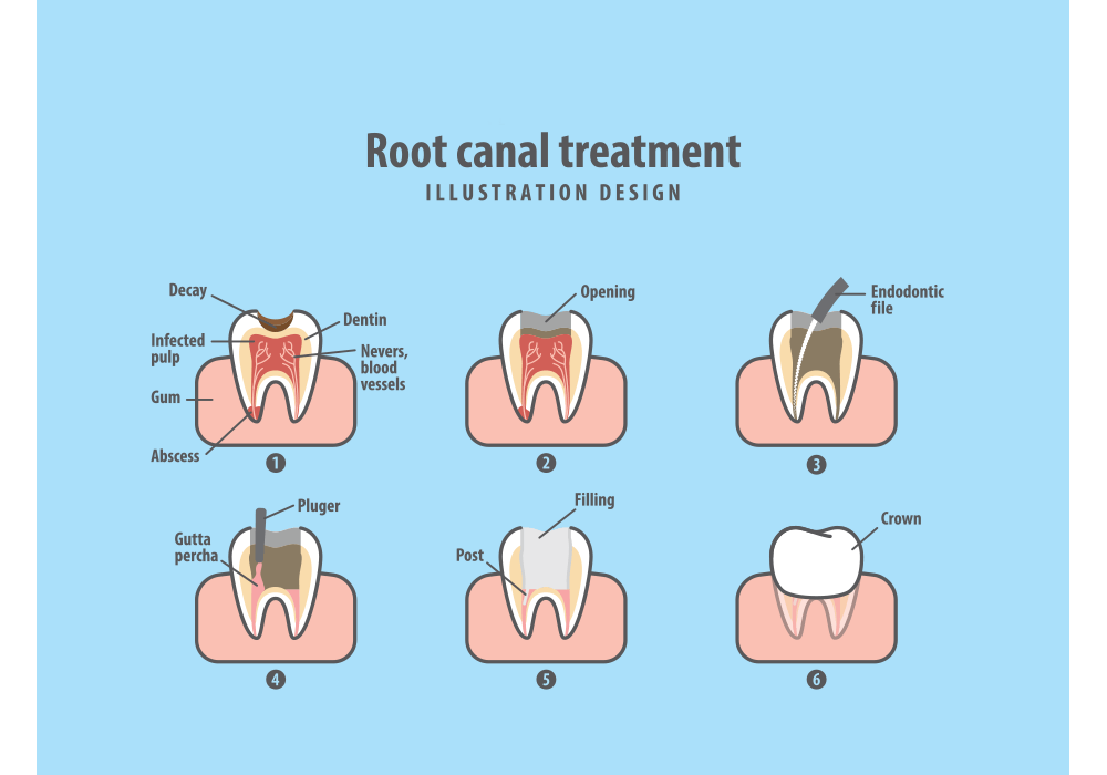 Root canal Therapy — Root canal treatment in Richmond, VA