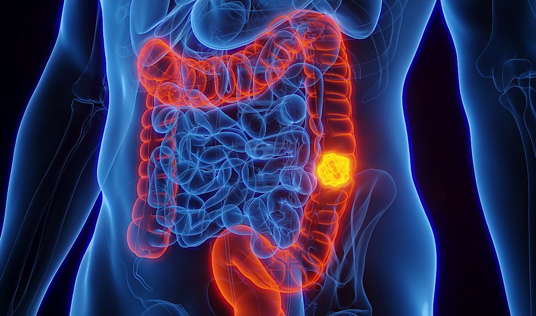 Digital diagram of colon showing colorectal cancer.