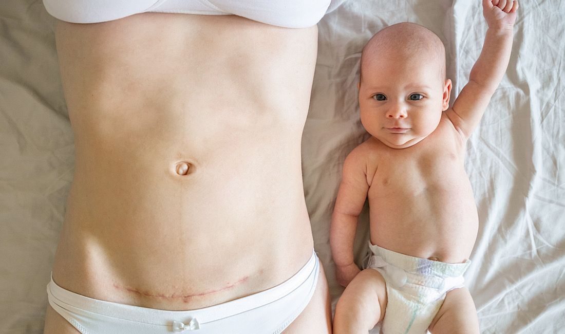 Sweet baby lying next to their mom, who has a visible c-section scar.