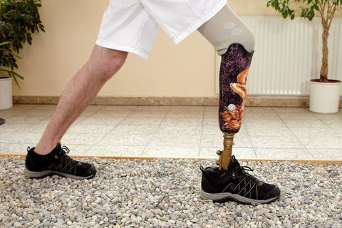 Person with Artificial Limb - Artificial Limbs