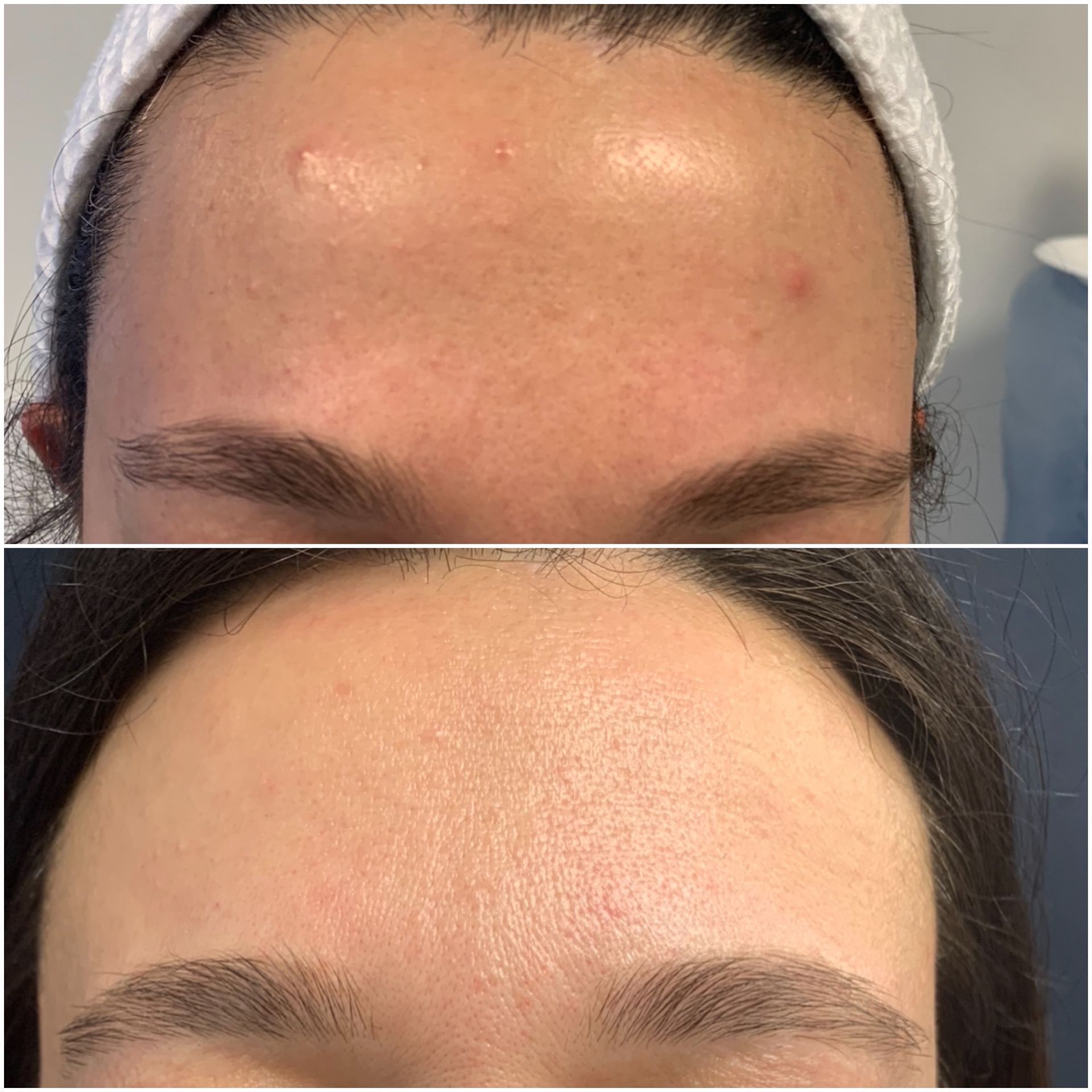 A before and after photo of a woman 's forehead with acne at Results Skincare Studio in Fort Myers