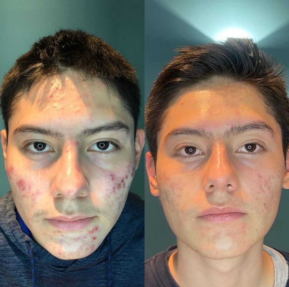 A before and after picture of a young man with acne on his face at Results Skincare Studio in Fort Myers