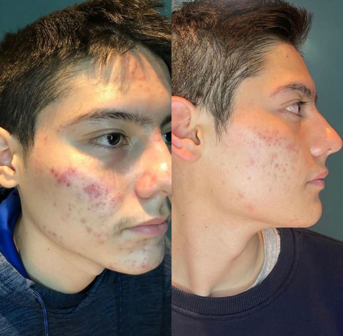 A before and after photo of a young man 's face with acne at Results Skincare Studio in Fort Myers