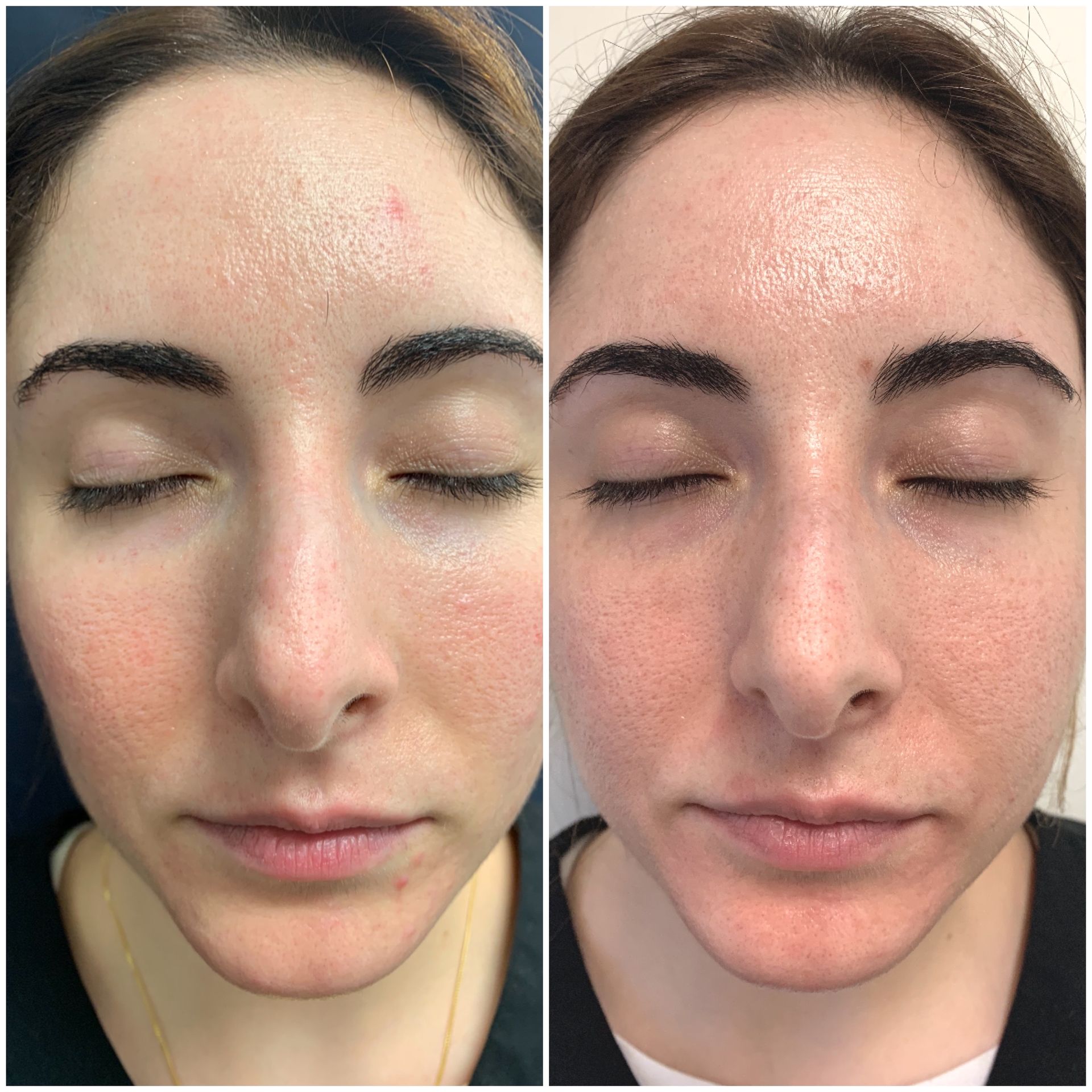A before and after photo of a woman 's face with her eyes closed at Results Skincare Studio in Fort Myers