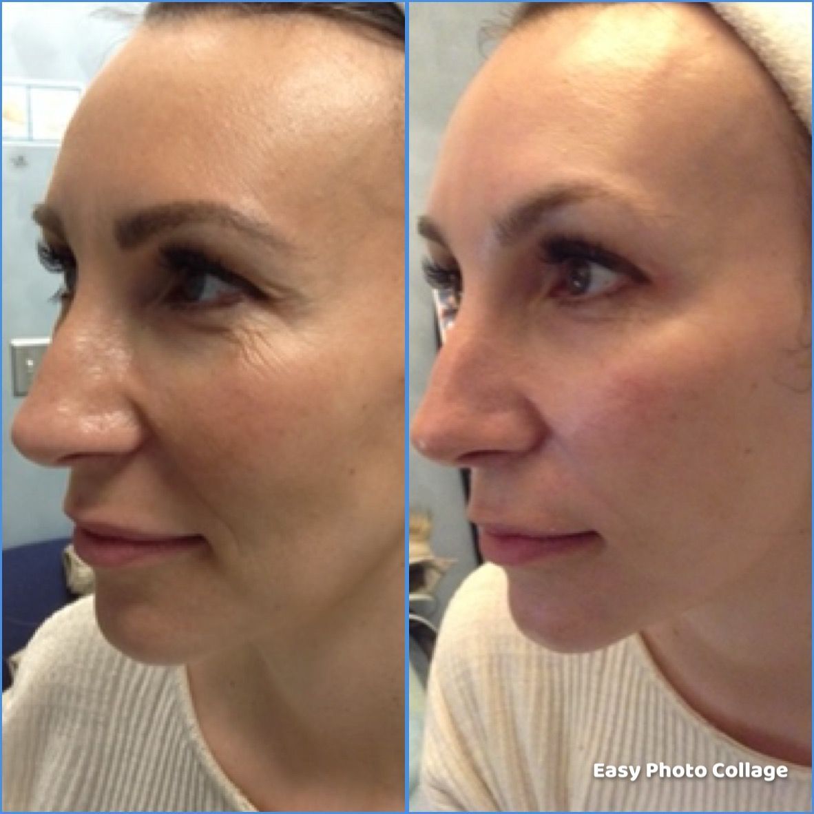 A before and after photo of a woman 's face at Results Skincare Studio in Fort Myers