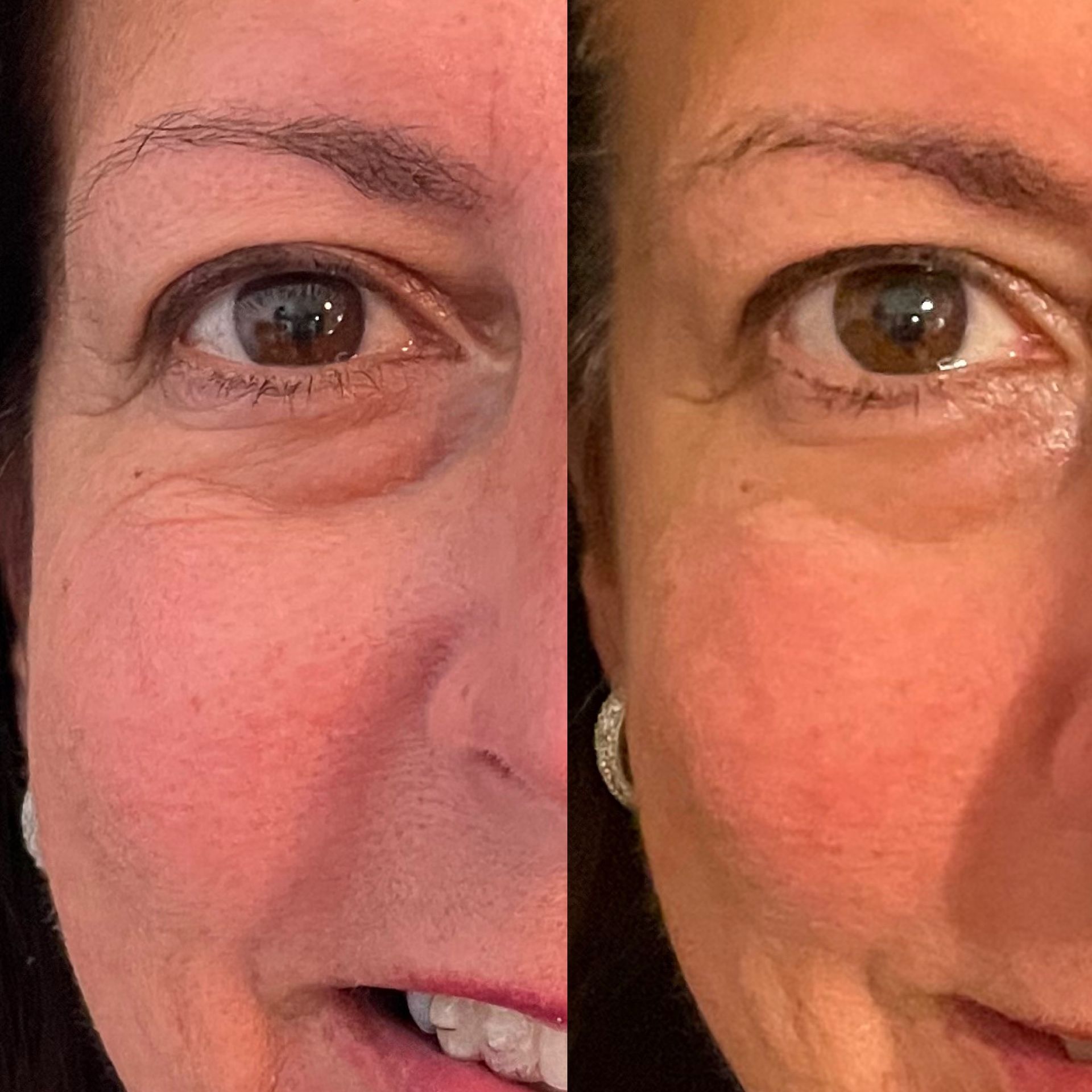 A before and after picture of a woman 's face at Results Skincare Studio in Fort Myers