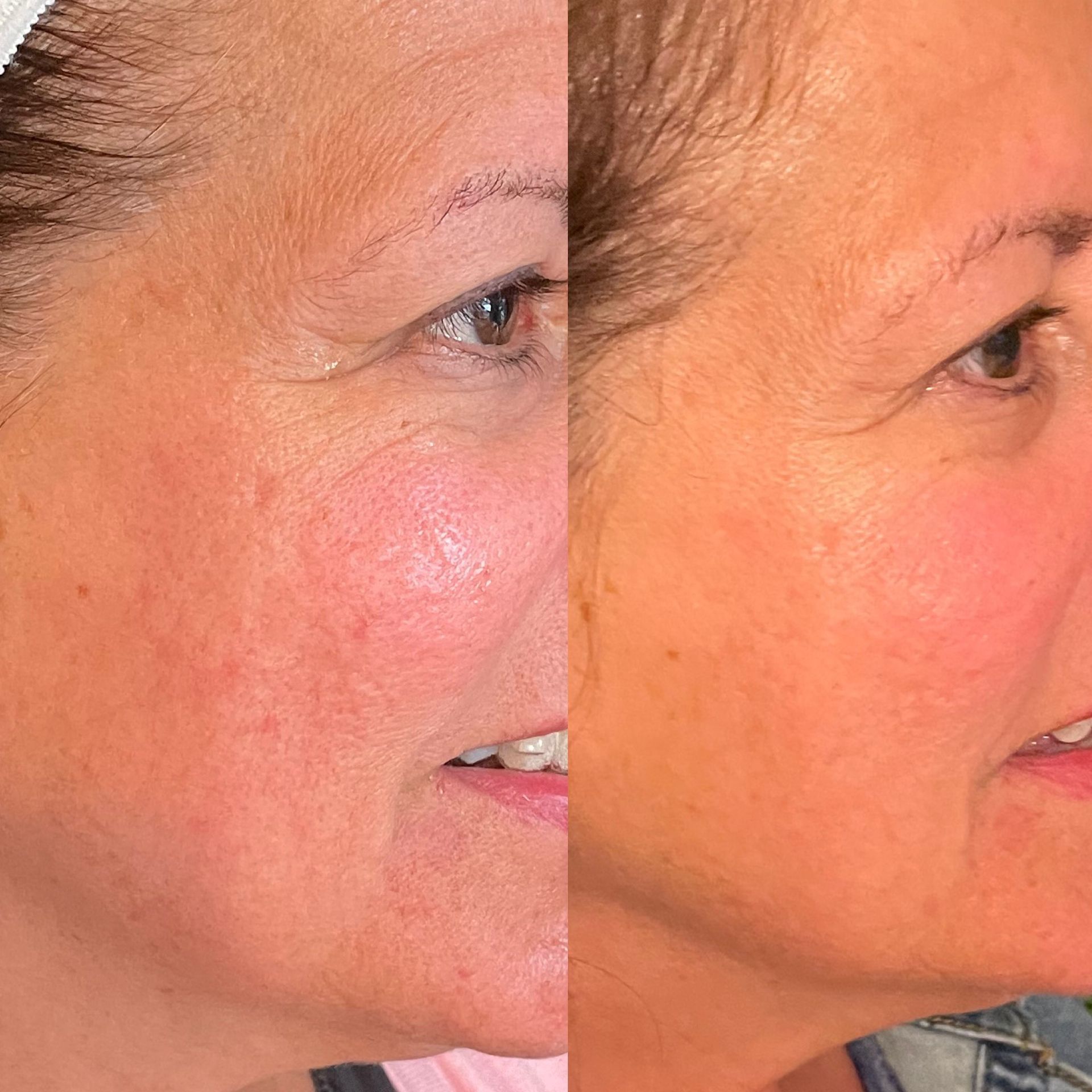 A woman 's face is shown before and after a treatment at Results Skincare Studio in Fort Myers