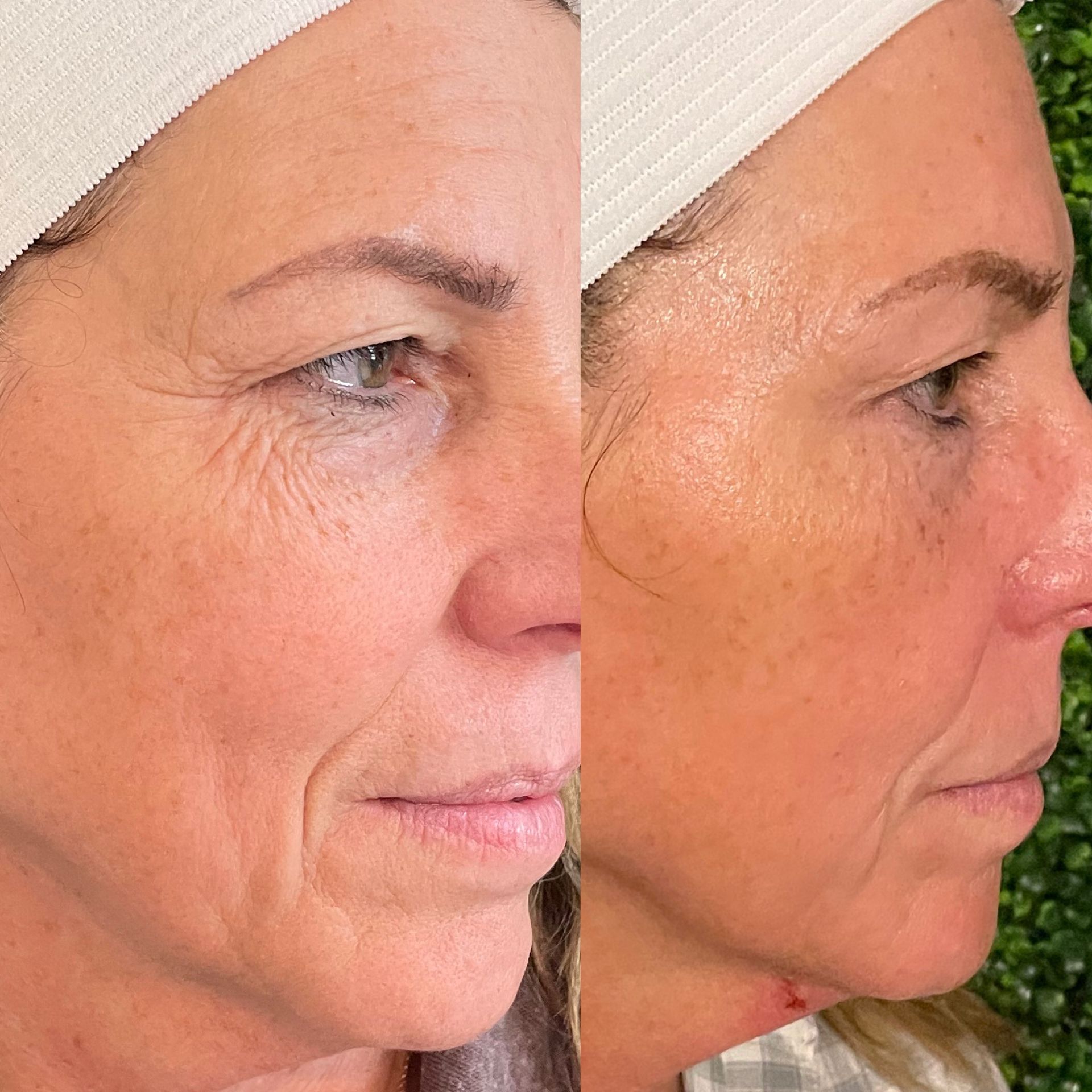 A before and after photo of a woman 's face at Results Skincare Studio in Fort Myers