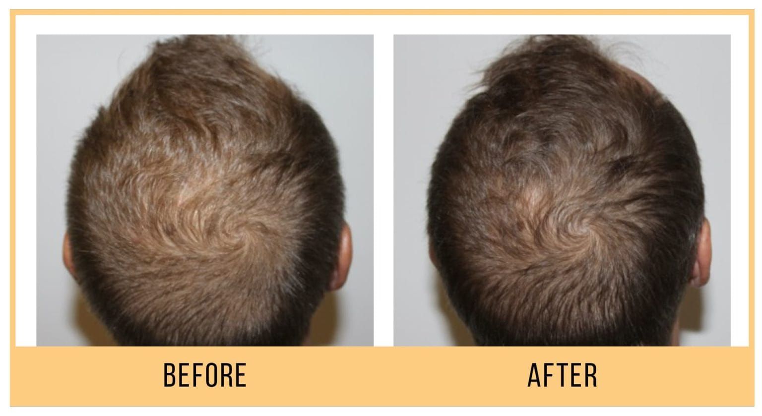 A before and after picture of a man 's hair growth at Results Skincare Studio in Fort