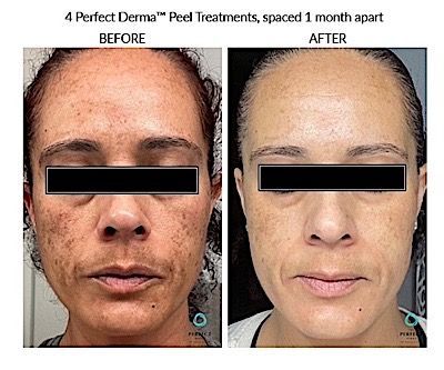 Before and after photos of a woman's face; skin discoloration significantly reduced after four Perfect Derma Peel treatments.