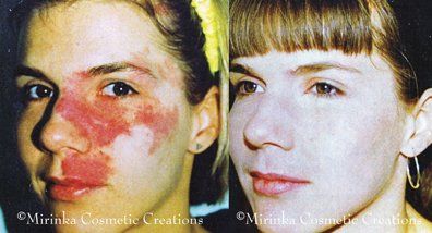 scar before and after