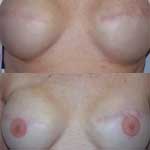 Before and After Nipple/Areola Re-Pigmentation