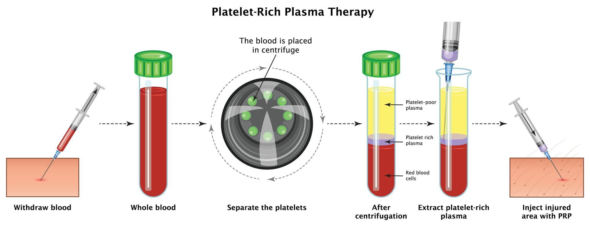 Platelet-Rich Plasma Therapy