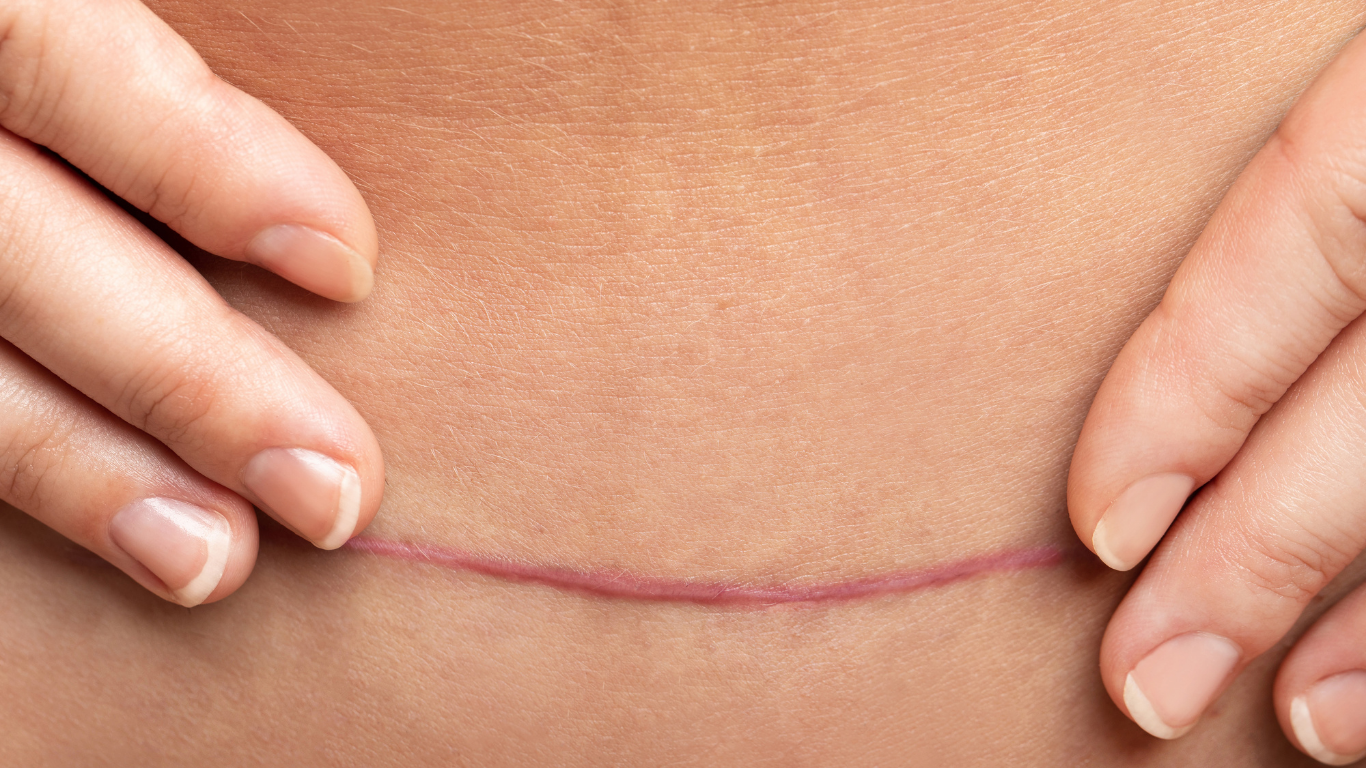 Hands holding up skin to display a curved scar on the abdomen.