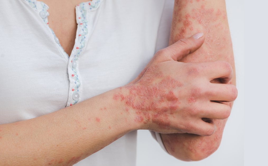 A woman is scratching her elbow with a rash on it.
