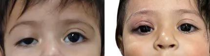 Ptosis congénita