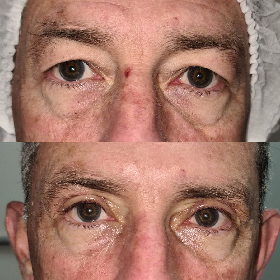 Blefaroplastia superior