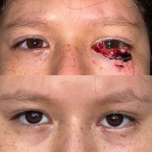 Cirugía reconstructiva ocular