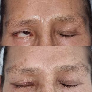 Cirugía reconstructiva ocular