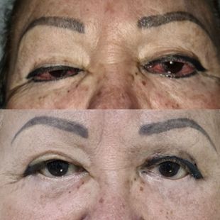Cirugía reconstructiva ocular