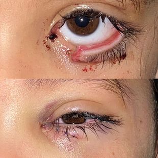 Cirugía reconstructiva ocular