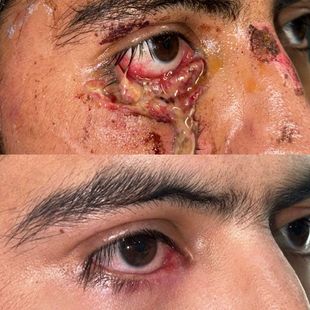 Cirugía reconstructiva ocular