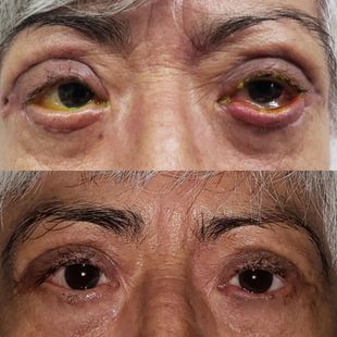 Cirugía reconstructiva ocular