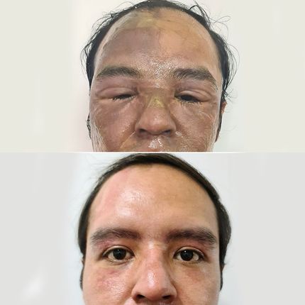 Corrección de quemaduras faciales