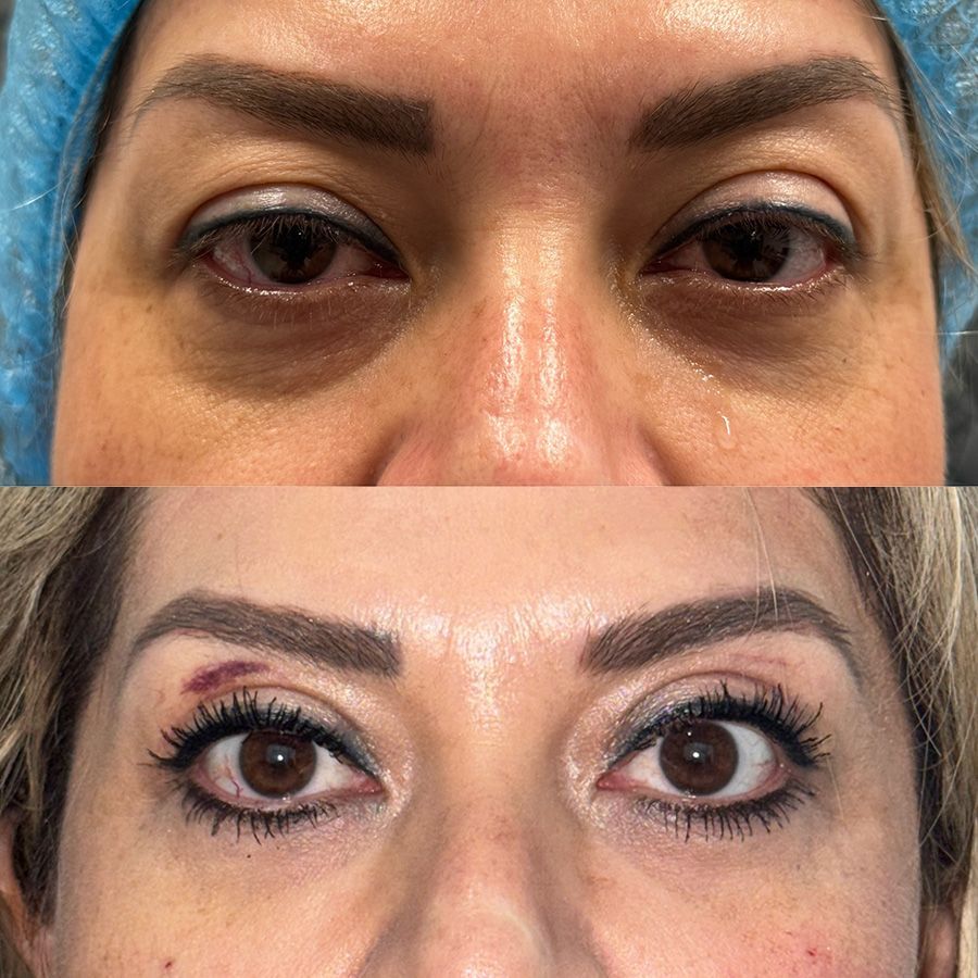 Blefaroplastia superior