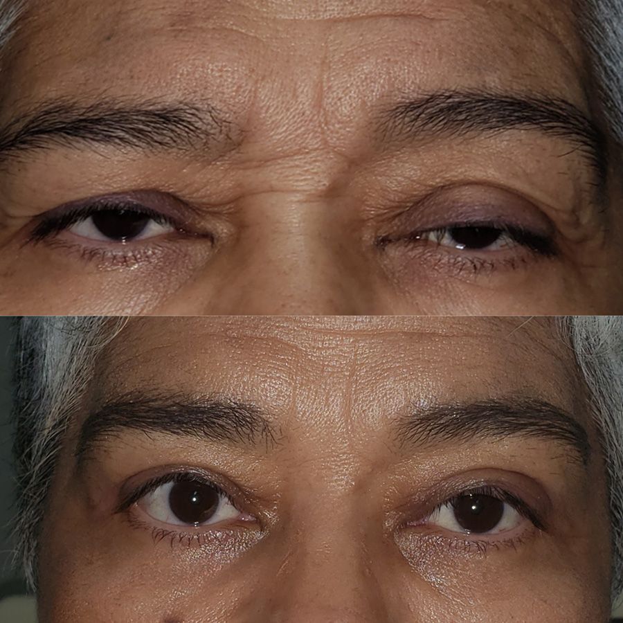 Blefaroplastia superior