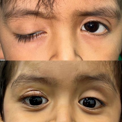 Ptosis congénita