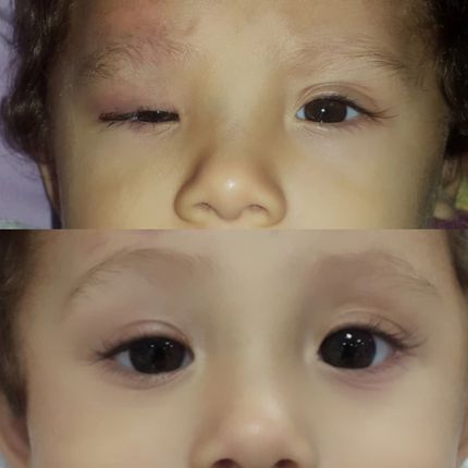 Ptosis congénita