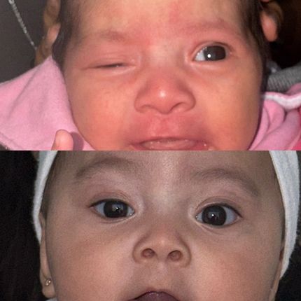 Ptosis congénita
