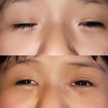 Ptosis congénita