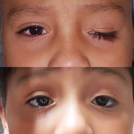 Ptosis congénita