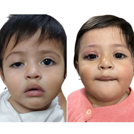 Ptosis congénita