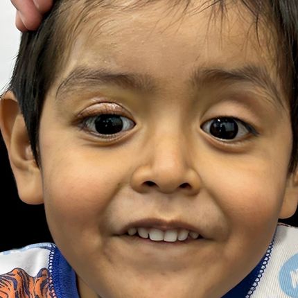 Ptosis congénita
