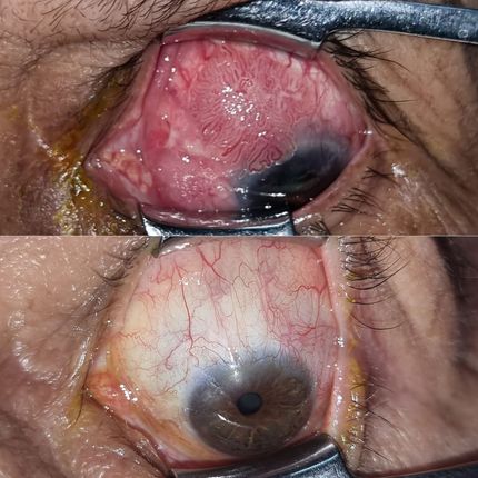 Tumores oculares y de superficie ocular