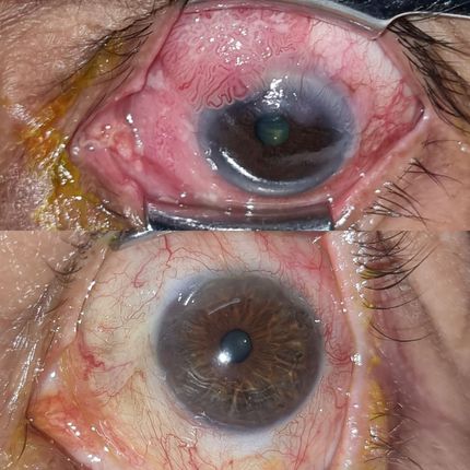 Tumores oculares y de superficie ocular