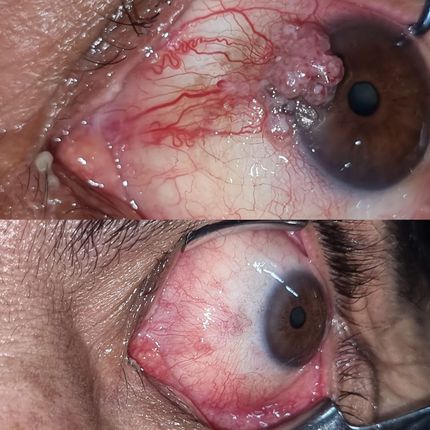 Tumores oculares y de superficie ocular