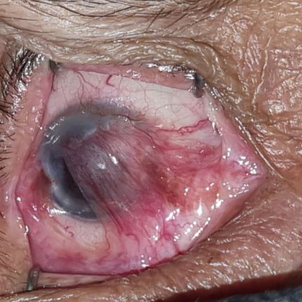 Tumores oculares y de superficie ocular