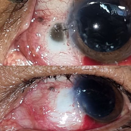 Tumores oculares y de superficie ocular