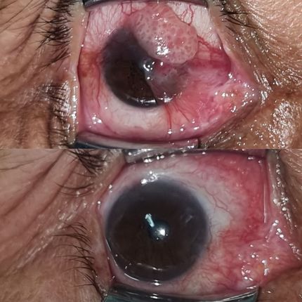 Tumores oculares y de superficie ocular